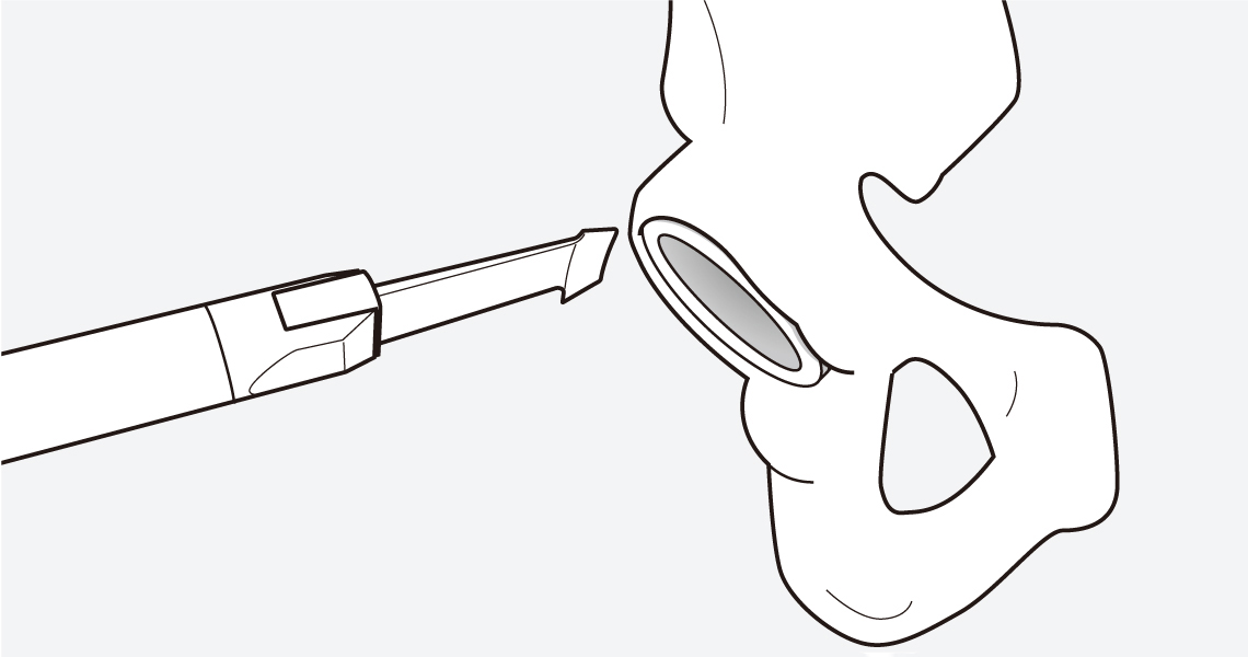 Detachment of Acetabular Rim by Edge Remover